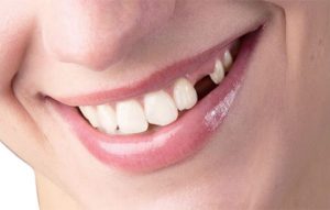mơ thấy rụng răng